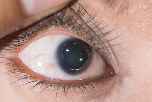 Marfanův-syndrom-zrak